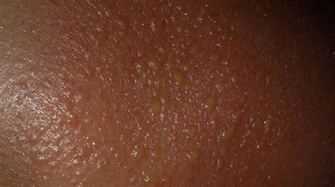 Sunburn Blisters: Symptoms, Treatments, and Complications